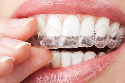 Αόρατη Ορθοδοντική