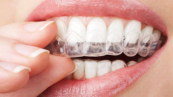 teethwithwhiteningtray Αόρατη Ορθοδοντική