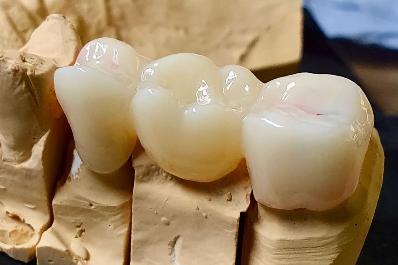 ολοκεραμικές θήκες & γέφυρες