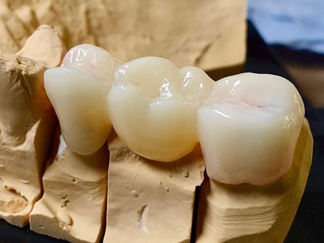 ολοκεραμικές θήκες & γέφυρες