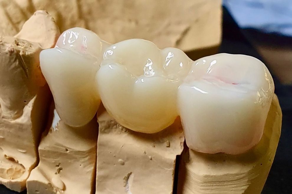 ολοκεραμικές θήκες & γέφυρες