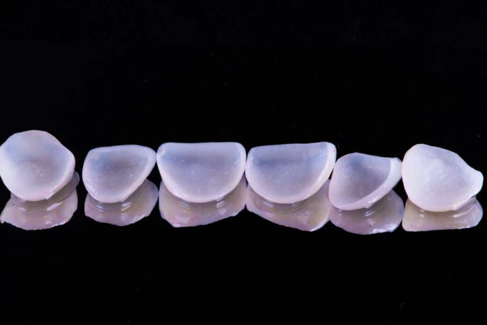 Όψεις Πορσελάνης