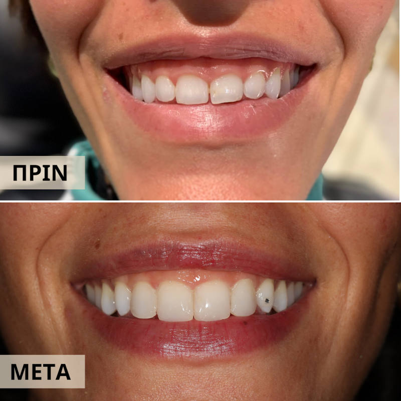 gumlifting800800 gumlifting800800