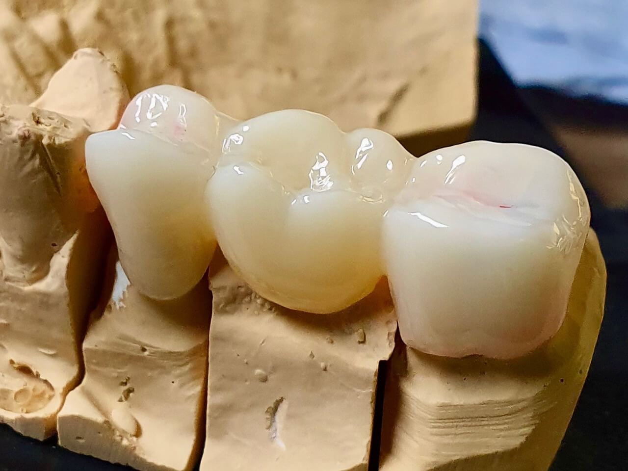 Allceramic Crowns www.thepearls.gr