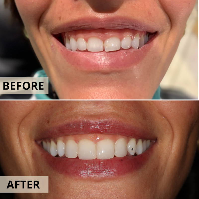 ΠΡΙΝ ΜΕΤΑ ΟΥΛΟΠΛΑΣΤΙΚΗ